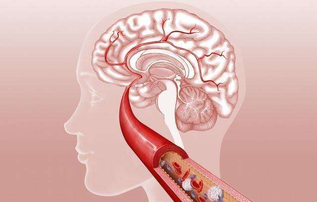 择思达斯 盘点脑血栓的五大治疗误区 