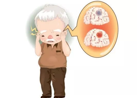 择思达斯经颅磁刺激仪_预防脑血栓生活中怎么做
